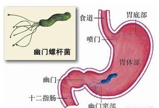 胃癌手术后粘膜出血的应对策略与治疗方案

引言
胃癌是全球范围内常见的恶性肿瘤之一，手术是治疗胃癌的主要手段。然而，手术后可能出现的并发症之一就是粘膜出血，这不仅影响患者的恢复，还可能危及生命。本文将探讨胃癌手术后粘膜出血的原因、应对策略及治疗方案。

一、胃癌手术后粘膜出血的原因
1.**手术创伤**手术过程中对胃壁的直接损伤可能导致术后出血。
2.**血管损伤**手术中可能损伤胃部血管，尤其是当肿瘤位置靠近大血管时。
3.**凝血功能障碍**患者术前或术后的凝血功能异常，如血小板减少或凝血因